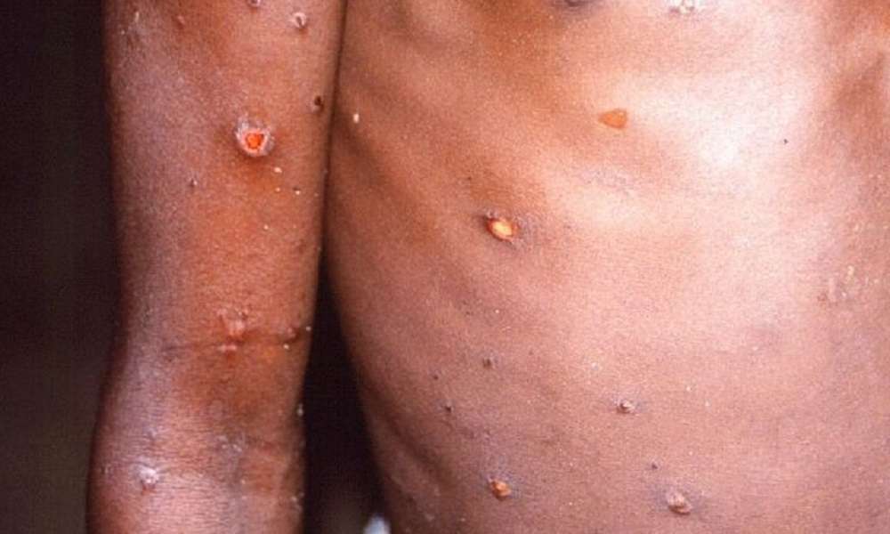 Αφρική – Σε κατάσταση έκτακτης υγειονομικής ανάγκης λόγω της ευλογιάς των πιθήκων