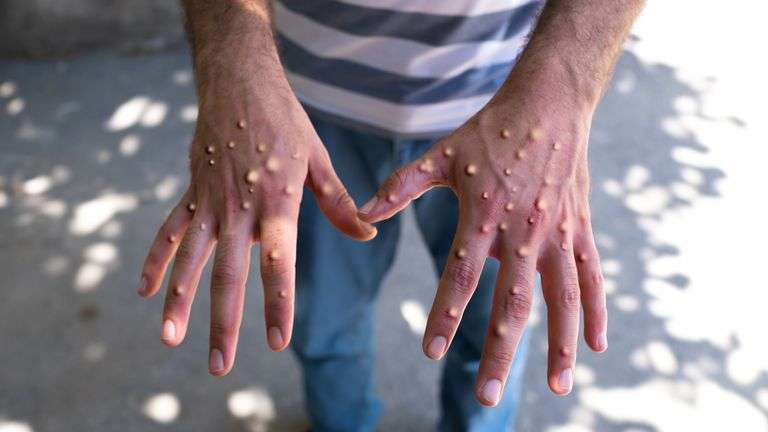 Νέο σοβαρό στέλεχος Mpox φτάνει στις ΗΠΑ καθώς αυξάνονται τα παγκόσμια κρούσματα