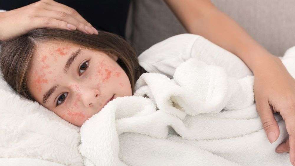 Συναγερμός για έξαρση ιλαράς – Η νόσος θα «φουντώσει» την άνοιξη