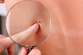 Παγκόσμια Ημέρα HPV: Καμπάνια ευαισθητοποίησης για τον ιό των ανθρώπινων θηλωμάτων