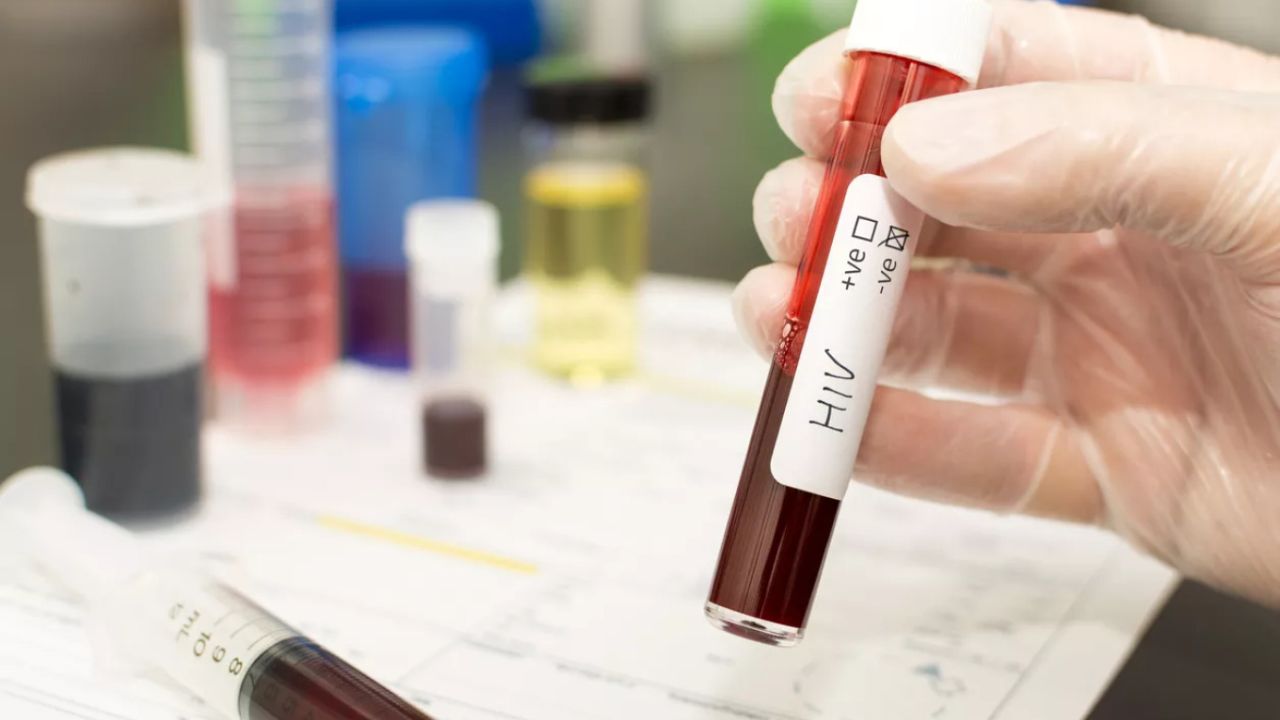 Συναγερμός για το AIDS: 21.800 κρούσματα HIV στην Ελλάδα – Ποιες δράσεις ξεκινούν