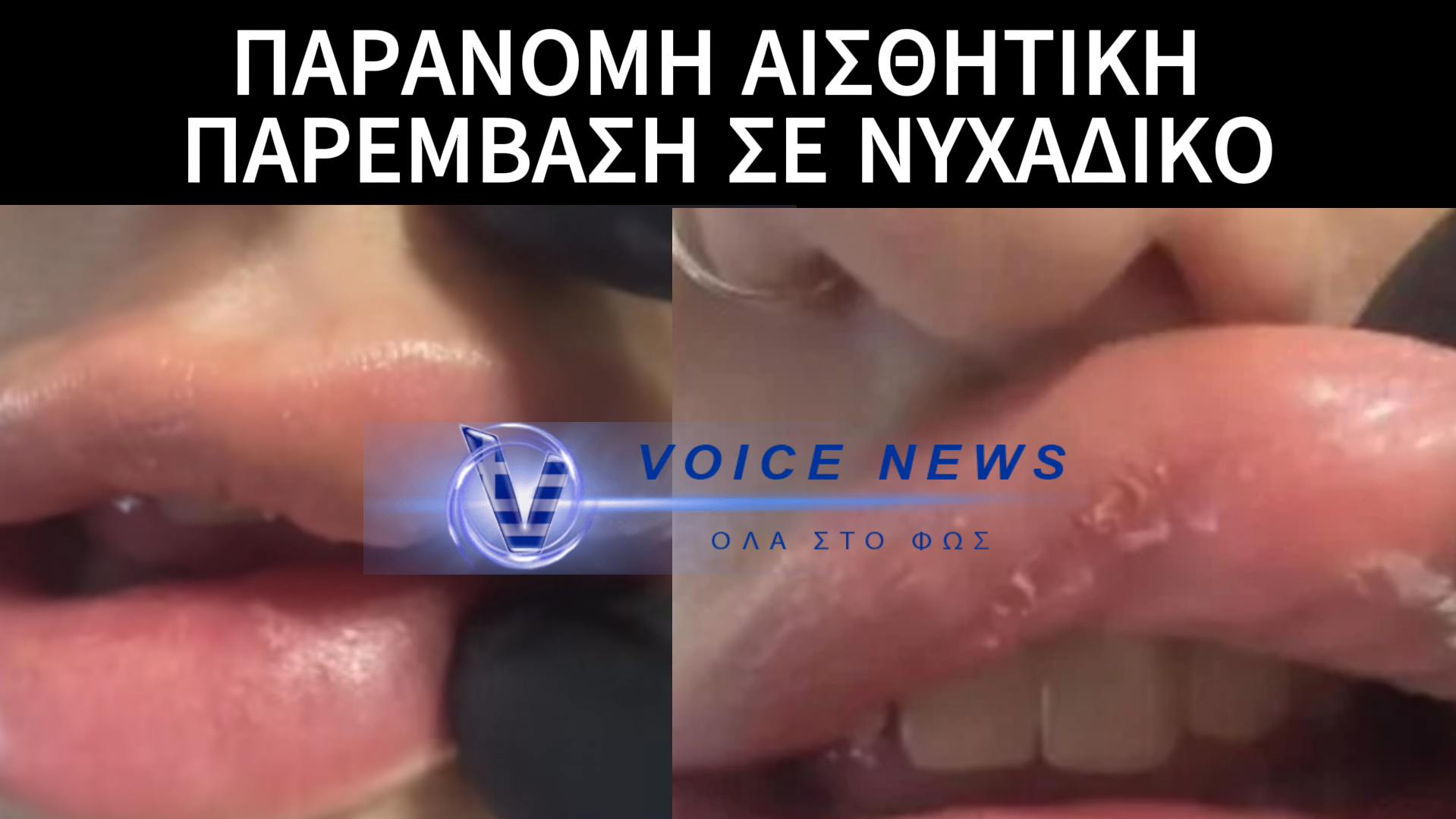 ΕΒΑΛΕ ΥΑΛΟΥΡΟΝΙΚΟ ΣΕ ΝΥΧΑΔΙΚΟ ΚΑΙ ΠΑΡΑΜΟΡΦΩΘΗΚΕ! ΑΠΙΣΤΕΥΤΗ ΠΕΡΙΠΕΤΕΙΑ ΠΟΥ ΖΗΤΑΝΕ ΤΑ ΡΕΣΤΑ ΑΠΟ ΤΟ ΘΥΜΑ