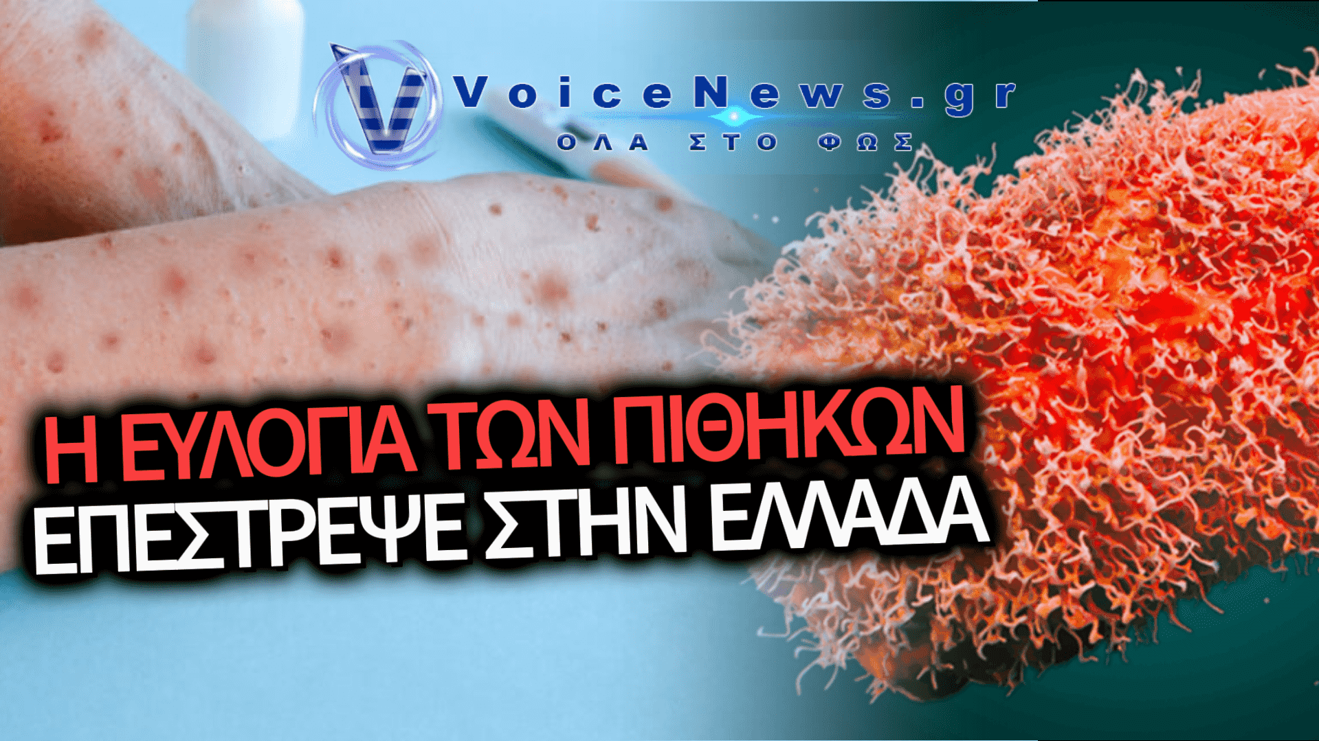 ΙΩΑΝΝΙΝΑ: ΣΥΝΑΓΕΡΜΟΣ ΣΤΙΣ ΥΓΕΙΟΝΟΜΙΚΕΣ ΑΡΧΕΣ — ΠΡΩΤΟ ΕΠΙΒΕΒΑΙΩΜΕΝΟ ΚΡΟΥΣΜΑ MPOX ΓΙΑ ΤΟ 2026 ΣΤΗΝ ΕΛΛΑΔΑ