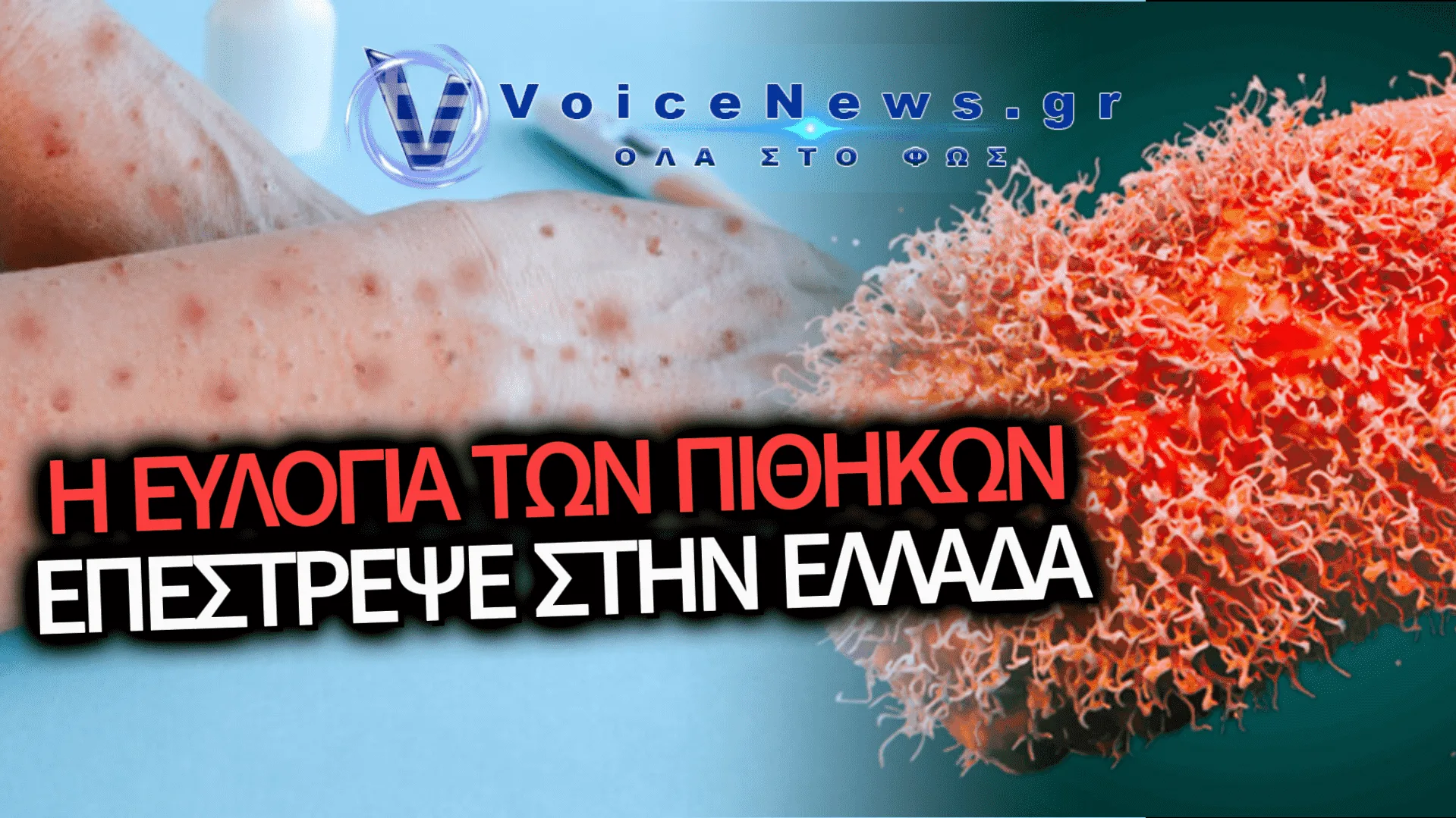 ΙΩΑΝΝΙΝΑ: ΣΥΝΑΓΕΡΜΟΣ ΣΤΙΣ ΥΓΕΙΟΝΟΜΙΚΕΣ ΑΡΧΕΣ — ΠΡΩΤΟ ΕΠΙΒΕΒΑΙΩΜΕΝΟ ΚΡΟΥΣΜΑ MPOX ΓΙΑ ΤΟ 2026 ΣΤΗΝ ΕΛΛΑΔΑ